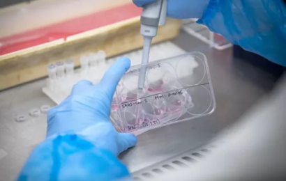 Irish Research Shows People With Long Covid Have Higher Measures Of Blood Clotting